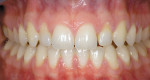 Figure 10  Preoperative image of a case requiring improving esthetic proportions.