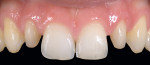 Figure 11  Preparations of the same case which shows the significantly pegged lateral that was present under the old composite bonding.