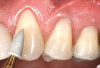 Fig 7. Subtle differences can be seen in the positions of denture teeth on a trial base.