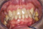 Figure 1  Gingival recession and inflammation associated with chronic mouth breathing.