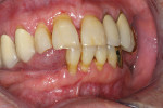 Figure 4  Typical appearance of medication-induced xerostomia (MIX disease) with dental caries.