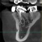 Tooth No. 30 periapical x-ray with periapical pathology not clearly visible and tooth No. 30 CBCT image with periapical pathology 4 mm in diameter.