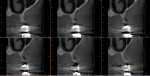 Panorax image with limited ability to determine bone thickness on upper right side. CBCT imaging shows full extent of horizontal bone loss in the area in question.