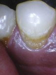 Case 2: decay removed.