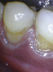 Case 2: gingivectomy/preparation.