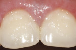 Case 1: Close-up detail of 10-day postoperative photograph.