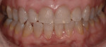 Frontal view shows flared out teeth Nos. 26 and 27.
