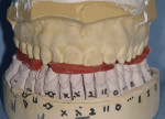 A three-piece CR bite registration with Red Pattern Resin was used to accurately articulate the prepared mandibular arch to the unprepared maxillary arch mounted on the SAM 3 articulator.