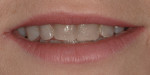 Frontal view after bonding was removed, showing exposed irregular dentin.