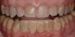 Frontal view shows how viscous liquid resin color modifier was used to blend provisionals to the maxillary dentition.
