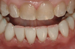 The pitch and bevel of the mandibular anterior restorations are established.