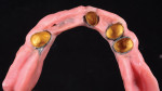 Fig 8 through Fig 10. The tooth positioning is transferred to the corrected master cast using a silicone putty matrix, and a complete wax try-in with hardware is performed.