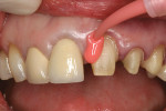 Figure 4  The top retraction cord was removed and Impregum light-body impression material was injected into the sulcus.