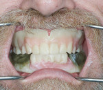 Fig 7. Definitive maxillomandibular records are
established using the preferred philosophy of
occlusion with an Aluwax record and index.