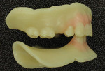 Fig 6. The mandibular posterior is used for an
Aluwax record index.