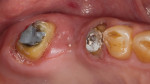 Fig 3. No major structural damage or decay on the existing tooth preparations.