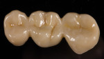 Fig 14. The final restoration ready for cementation.