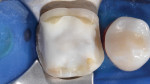 Fig 3. Discolored dentin areas were covered with an opaque build-up restoration.