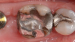 Fig 1. Clinical examination revealed insufficient amalgam restorations on the patient’s lower right first molar and second premolar.