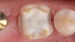 Fig 4. The abutment tooth was prepared according to guidelines for all-ceramic CAD/CAM restorations.