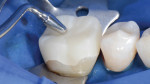 Fig 9. The restoration was checked for fit prior to cementation.