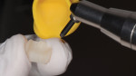 Fig 10. The part of the restoration facing the tooth was air abraided with aluminum oxide.