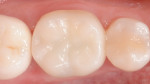 Fig 16. Occlusal view 1 year after cementation.
