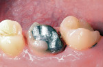 Figure 1A  Completed crown preparation for maxillary molar.