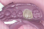 Figure 1C  After 75 seconds, the PVS template was removed from the mouth with the interim crown in the template.