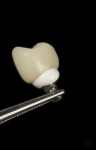 Fig 6. Cementation process of a hybrid ceramic implant crown on a titanium abutment.