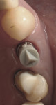 Fig 14. Preparation of the tooth and inserted scan post - ready to take an optical impression