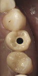 Fig 15. Cemented restoration and screw-retained implant crown