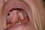 Extraction was eliminated as a treatment option due to BRONJ of a palatal torus. Clinical photograph showing lesion.