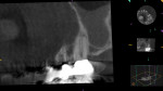 Extraction was eliminated as a treatment option due to BRONJ of a palatal torus. CBCT images were necessary to make the diagnosis because of the patient’s inability to tolerate traditional radiographs.