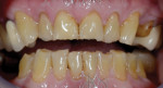 Example from another case of incisal edge wear from bruxing and possible OSA and GERD.