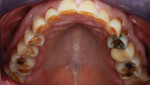 The patient demonstrated occlusal disease signs of abrasive and erosive wear. Testing was positive for severe bruxism, severe obstructive sleep apnea, and gastroesophageal reflux.