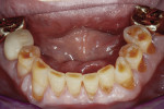The patient demonstrated occlusal disease signs of abrasive and erosive wear. Testing was positive for severe bruxism, severe obstructive sleep apnea, and gastroesophageal reflux.