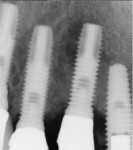 Initial radiographic presentation demonstrating a large radiolucency around the apical half of the implant at tooth No. 6.