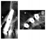 CBCT of a cross-section (left) and coronal slice (right) of tooth No. 6 demonstrating 5 years post peri-implantitis treatment maintenance of the buccal plate and no return of the initial periodontal problem.
