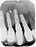 Periapical radiograph taken post-surgically demonstrating defect filled with the osseous graft material.