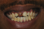 Preoperative close-up smile, showing shorter teeth, open bite, and reverse smile line.