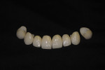The definitive (pressed) lithium-disilicate IPS e.max restorations. A zirconia coping was used on only the right central incisor (tooth No. 8) to complete the masking of the underlying composite resin. (Note: The same layering porcelain was used on this restoration as for all the others.)