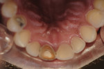 Preoperative occlusal view of lingual wear.