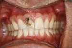 Figure 1  Clinical photograph of tooth No. 8.