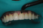 Restorations were tacked at the gingival margin with the curing light.