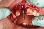 Figure 5  Hand placement of a 4.3-mm X 10-mm surgical bur into the socket.