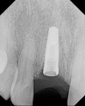 Figure 8  Final radiograph confirmed ideal implant placement (depth and angle).