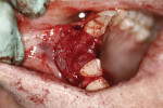Figure 10  Placement of the membrane over the grafted site, before closure of the flap.