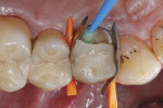 Fig 7. A multimode adhesive was applied in the area of the fracture site on respective dentin, enamel, and glass-ceramic surfaces.