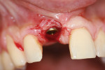 Figure 16  Keratinized tissue displaced to the facial aspect of the implant, supported by a healing abutment.